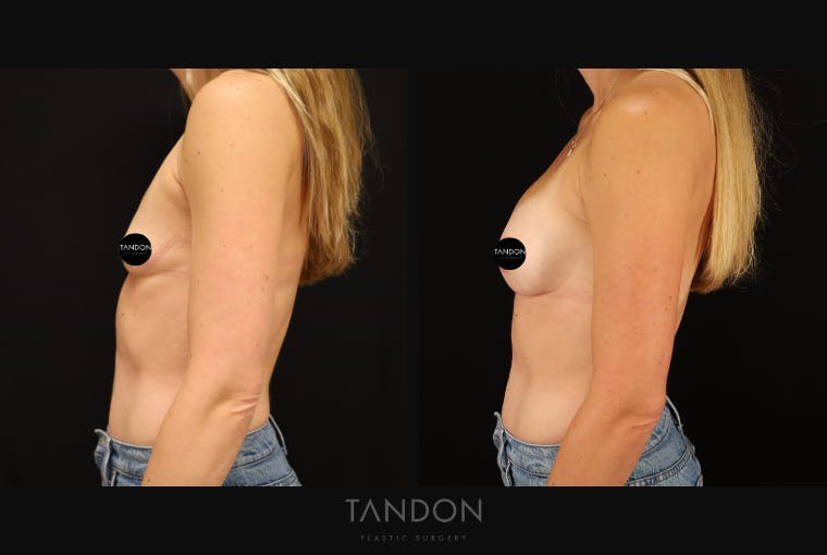 Breast Augmentation Before & After Gallery - Patient 313278 - Image 2