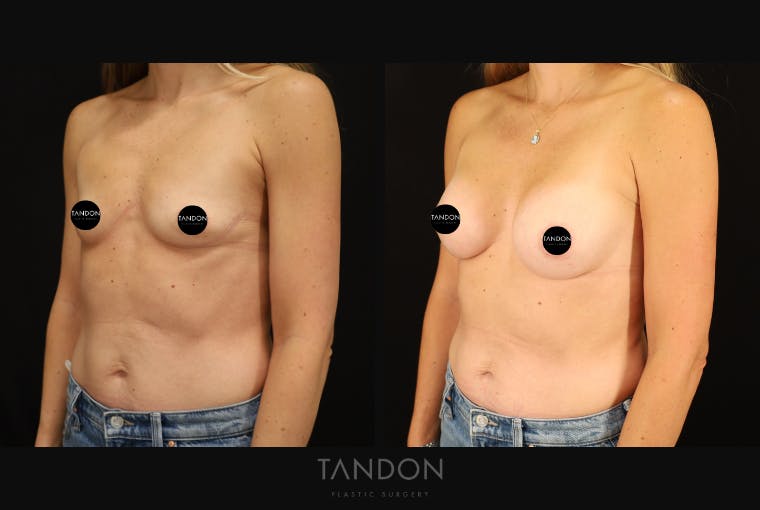 Breast Augmentation Before & After Gallery - Patient 313278 - Image 3