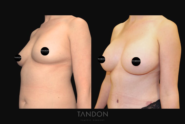 Breast Augmentation Before & After Gallery - Patient 209975 - Image 3