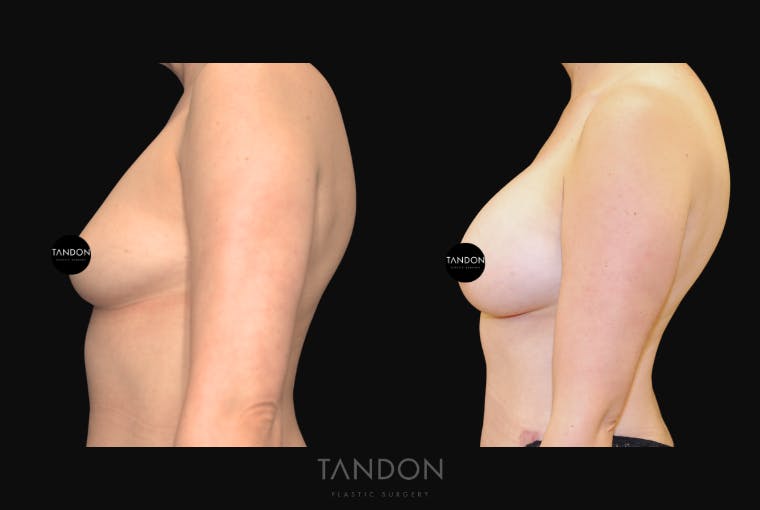 Breast Augmentation Before & After Gallery - Patient 209975 - Image 2