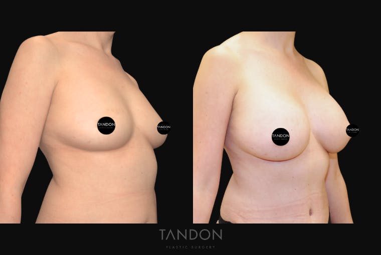 Breast Augmentation Before & After Gallery - Patient 209975 - Image 4