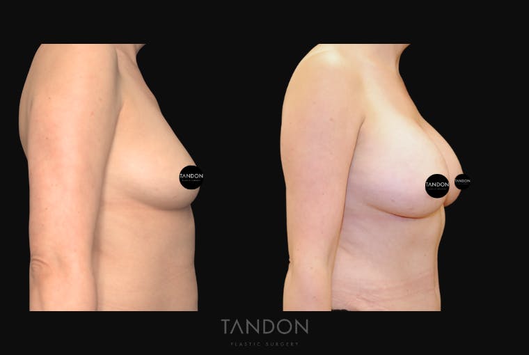 Breast Augmentation Before & After Gallery - Patient 209975 - Image 5