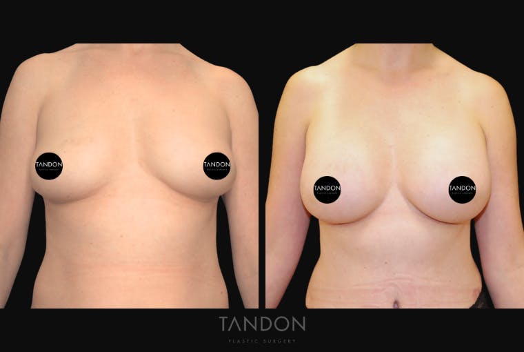Breast Augmentation Before & After Gallery - Patient 209975 - Image 1