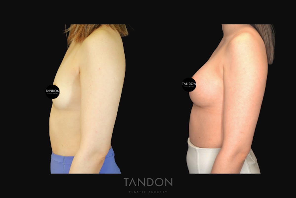 Breast Augmentation Before & After Gallery - Patient 167079 - Image 5
