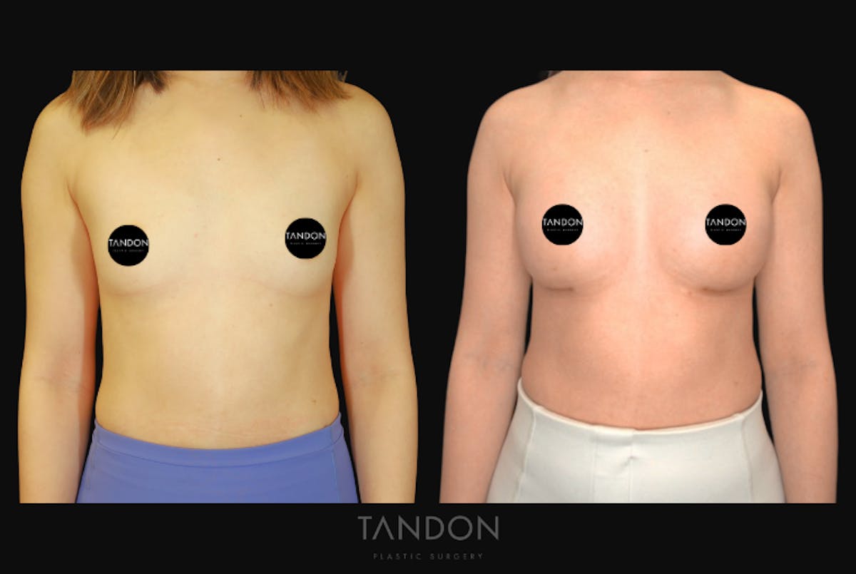 Breast Augmentation Before & After Gallery - Patient 167079 - Image 1