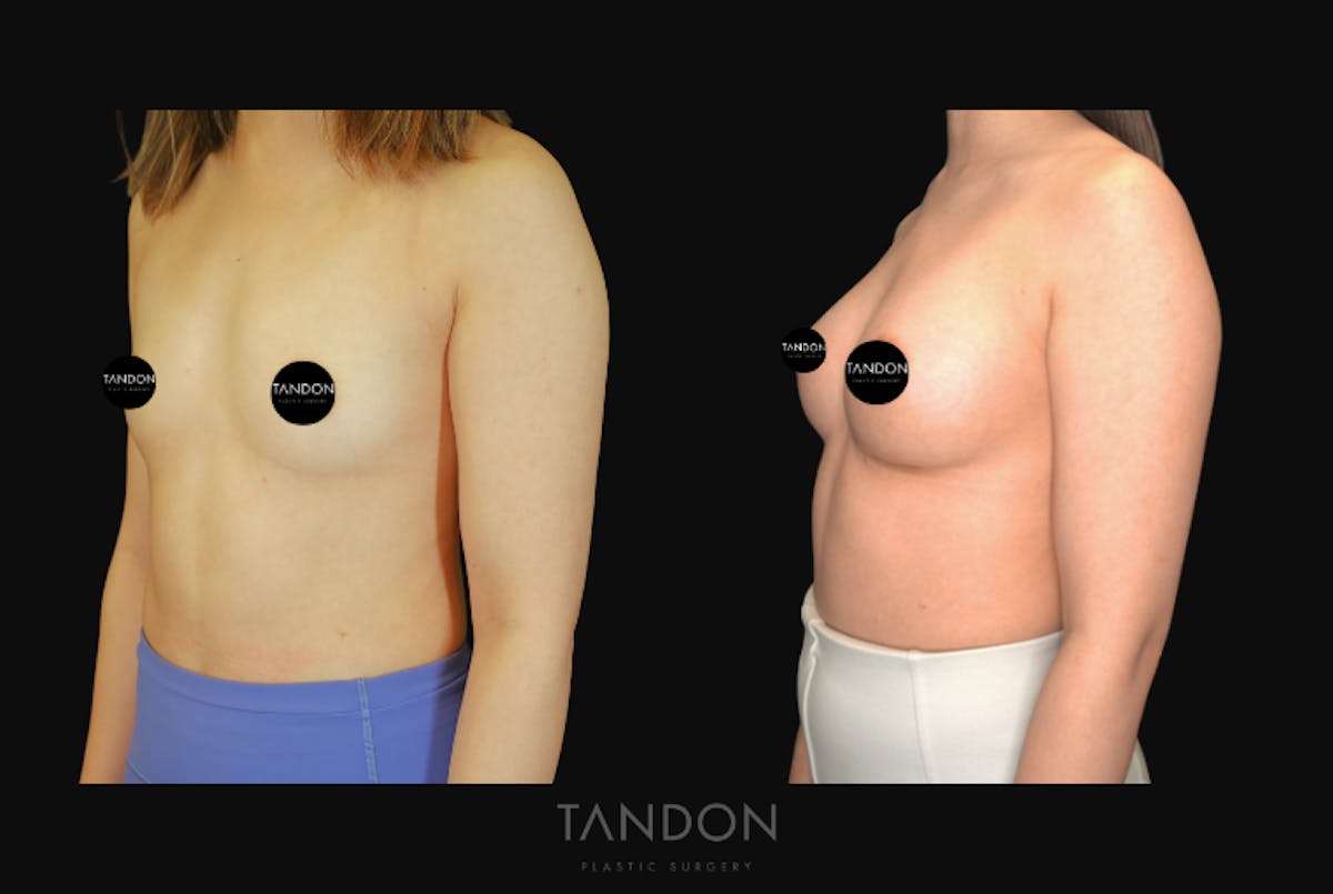 Breast Augmentation Before & After Gallery - Patient 167079 - Image 2