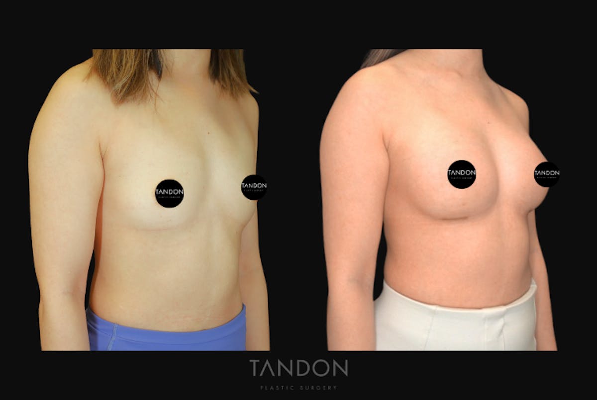 Breast Augmentation Before & After Gallery - Patient 167079 - Image 4