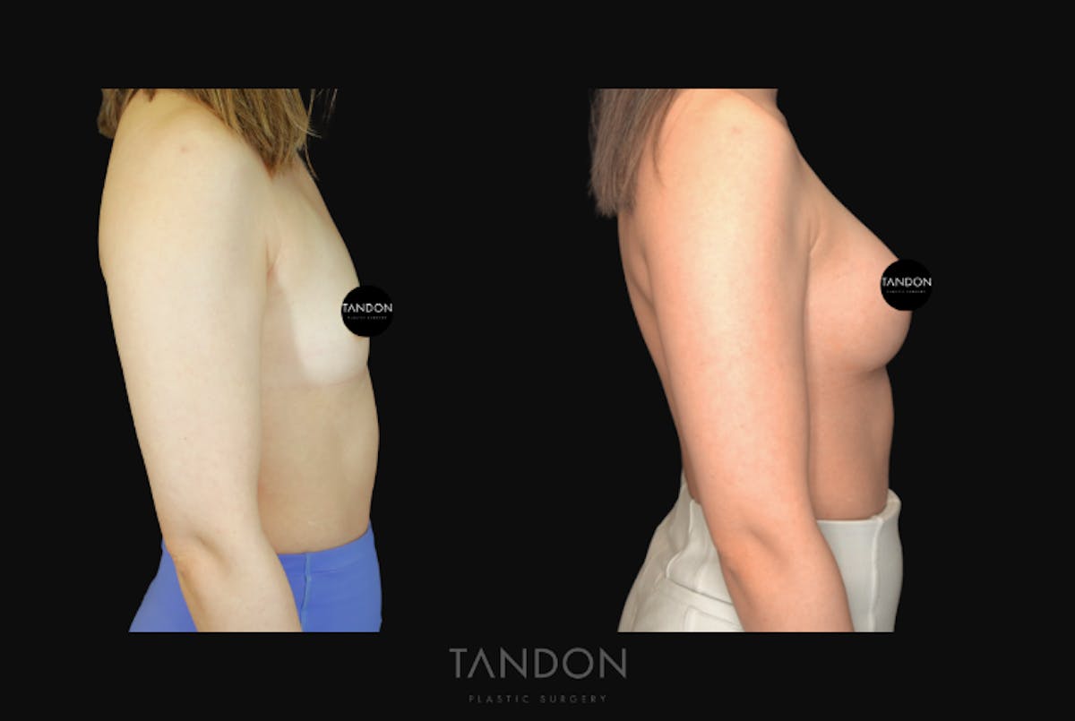 Breast Augmentation Before & After Gallery - Patient 167079 - Image 3