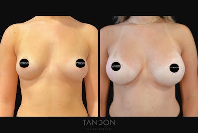 Breast Augmentation Before & After Gallery - Patient 513896 - Image 1