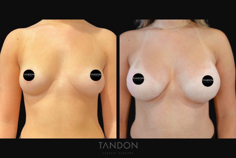 Breast Augmentation Before & After Gallery - Patient 513896 - Image 1