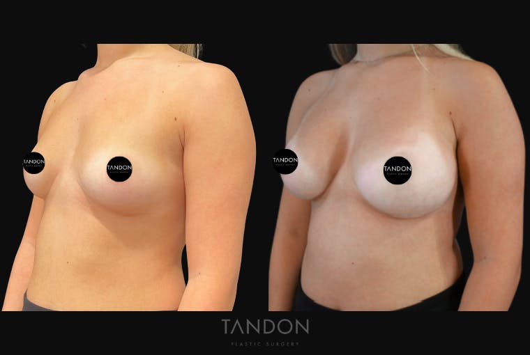 Breast Augmentation Before & After Gallery - Patient 513896 - Image 2