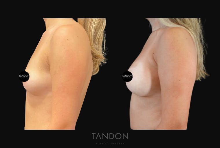 Breast Augmentation Before & After Gallery - Patient 513896 - Image 3