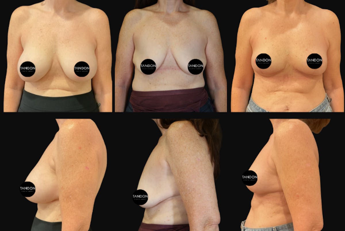 Breast Lift Before & After Gallery - Patient 119015 - Image 1