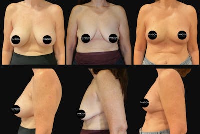 Breast Lift Before & After Gallery - Patient 119015 - Image 1