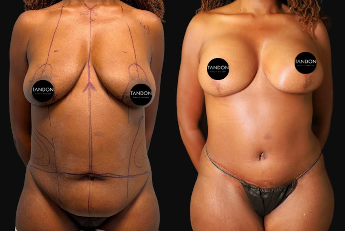Breast Lift Before & After Gallery - Patient 336278 - Image 1