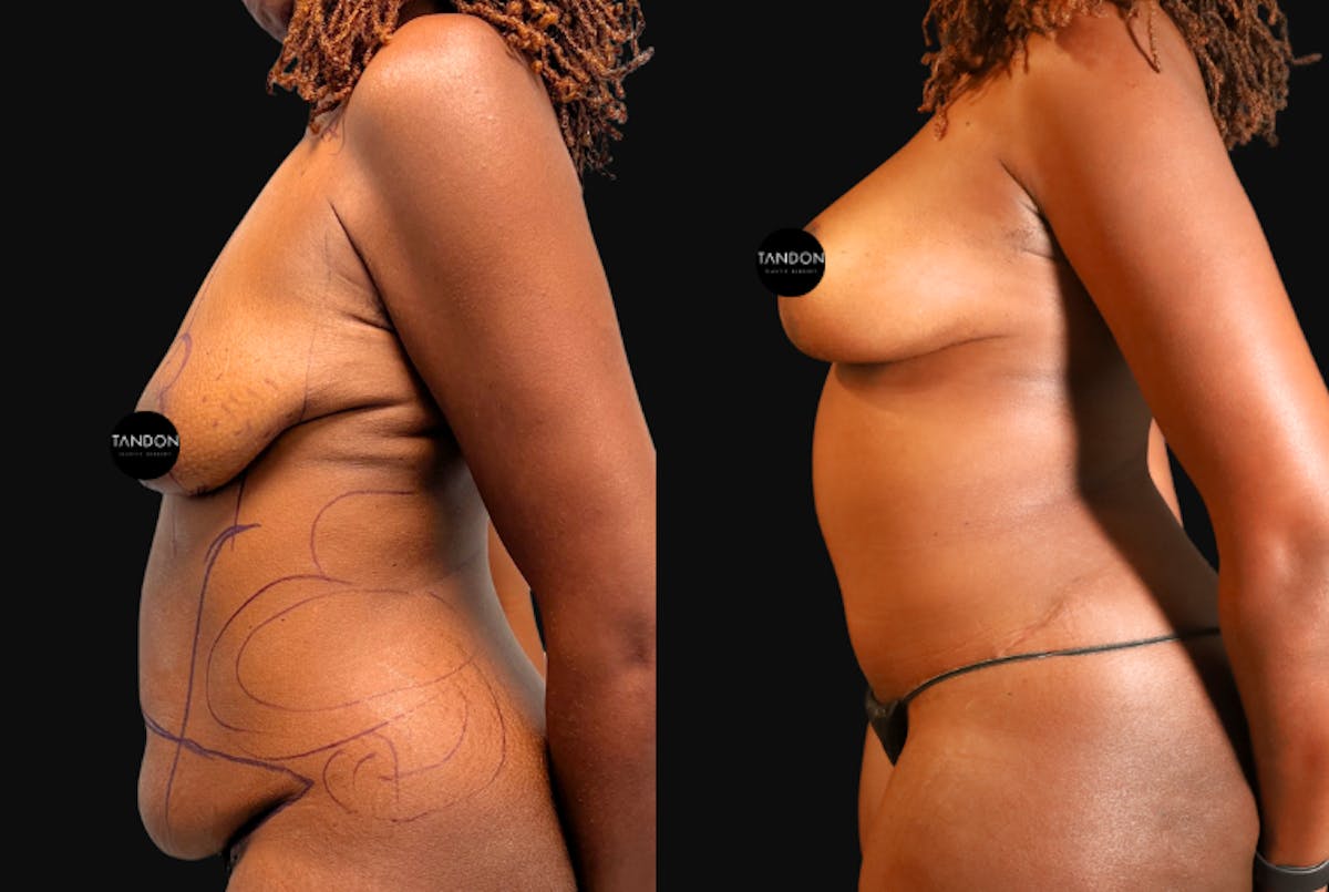 Breast Lift Before & After Gallery - Patient 336278 - Image 2