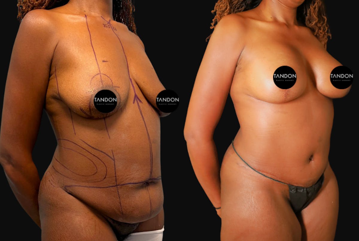 Breast Lift Before & After Gallery - Patient 336278 - Image 4