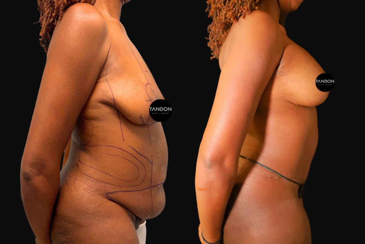 Breast Lift Before & After Gallery - Patient 336278 - Image 3