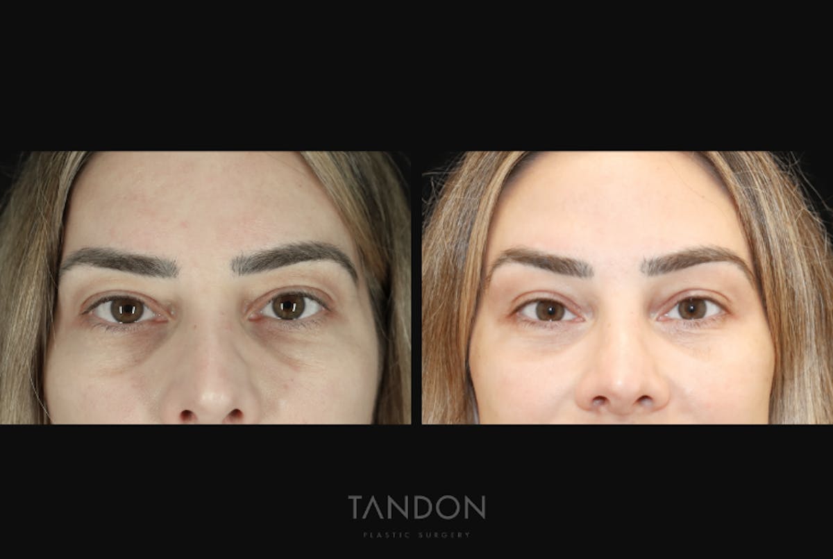 Blepharoplasty Before & After Gallery - Patient 168462 - Image 1
