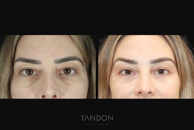 Blepharoplasty Before & After Gallery - Patient 168462 - Image 1
