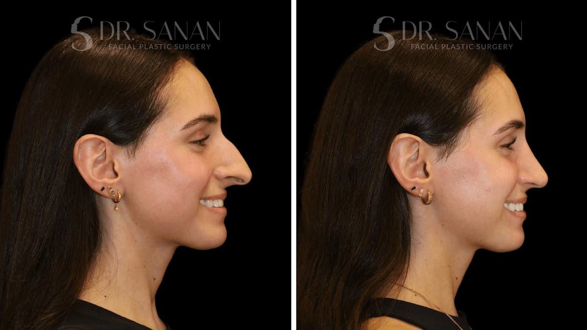 Rhinoplasty Before & After Gallery - Patient 377399 - Image 1
