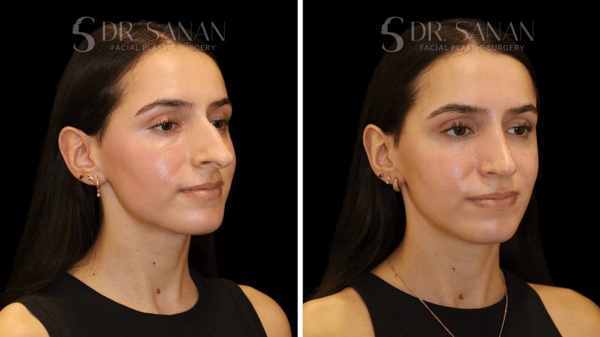 Rhinoplasty Before & After Gallery - Patient 377399 - Image 2