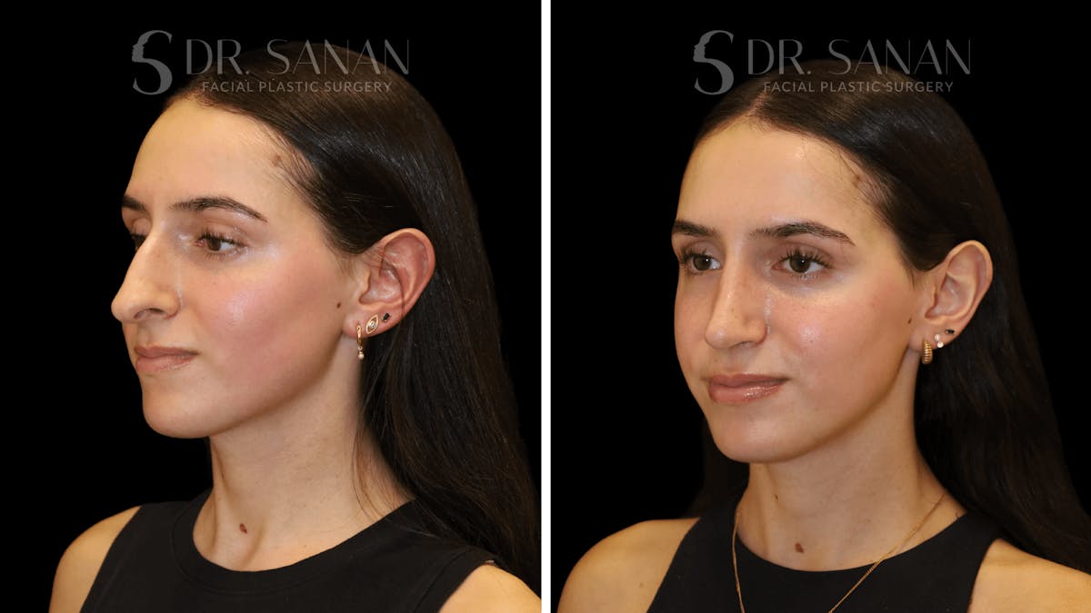 Rhinoplasty Before & After Gallery - Patient 377399 - Image 3