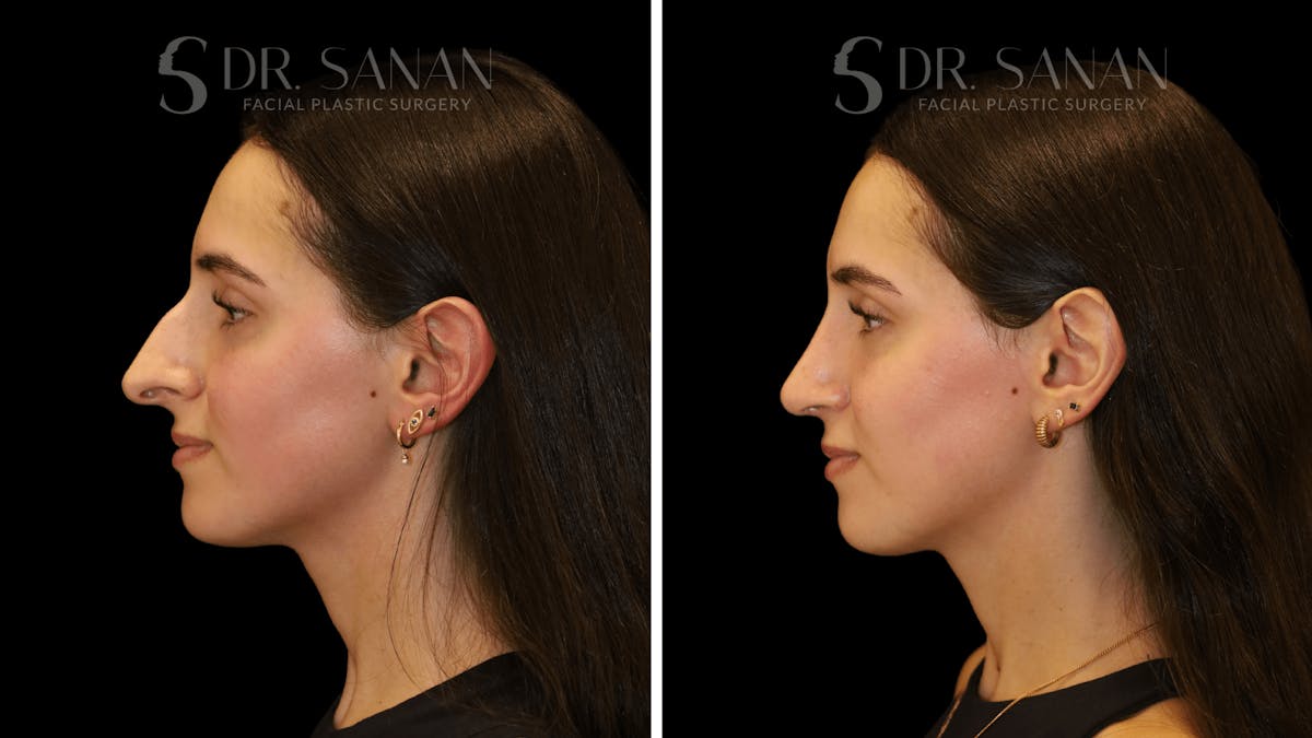 Rhinoplasty Before & After Gallery - Patient 377399 - Image 4