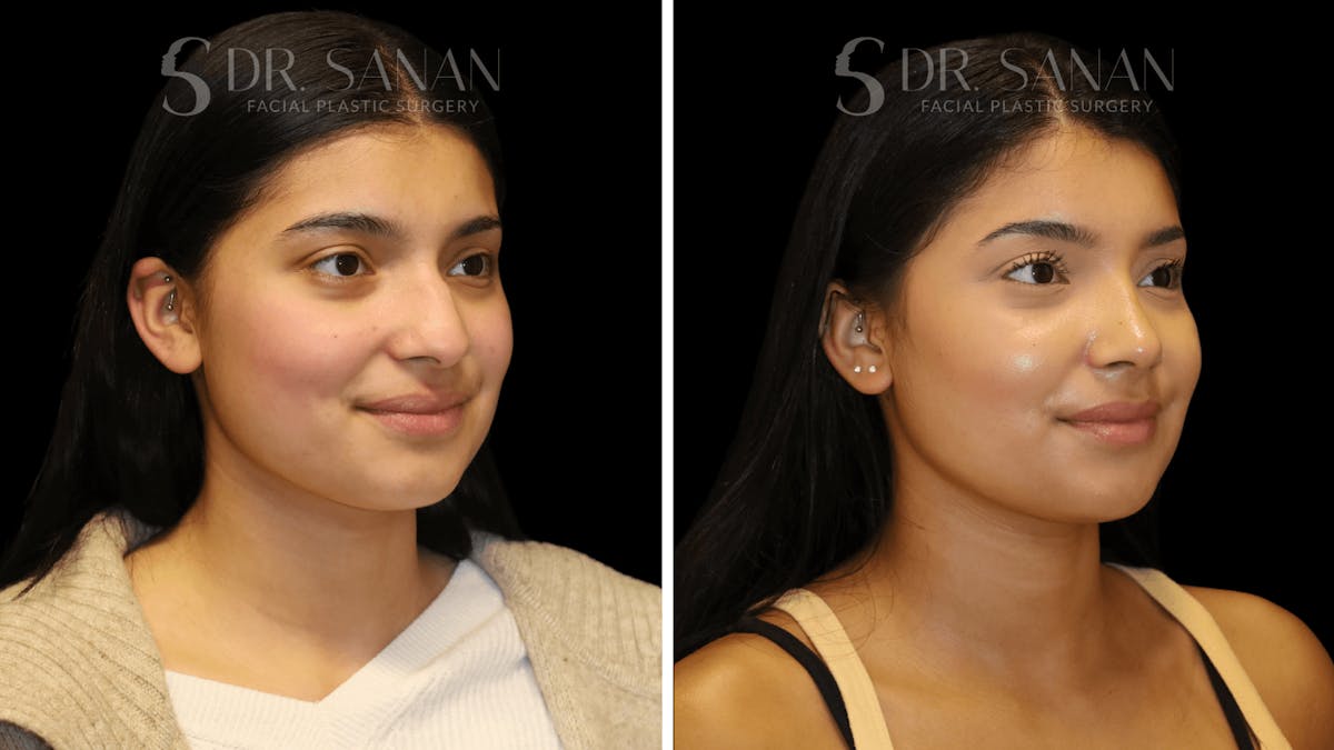 Rhinoplasty Before & After Gallery - Patient 142101 - Image 3