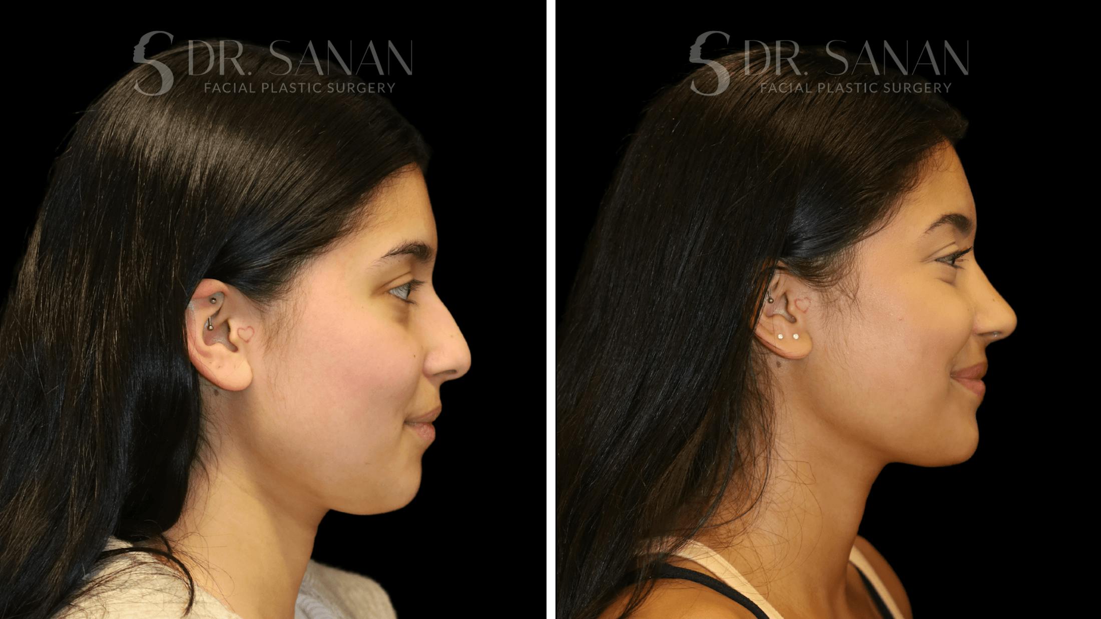 Rhinoplasty Before & After Gallery - Patient 142101 - Image 1