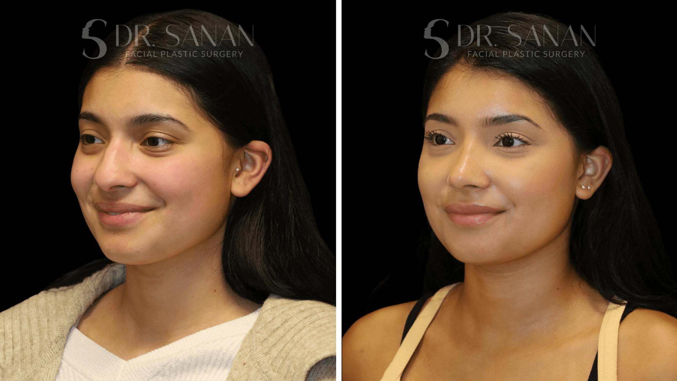 Rhinoplasty Before & After Gallery - Patient 142101 - Image 4