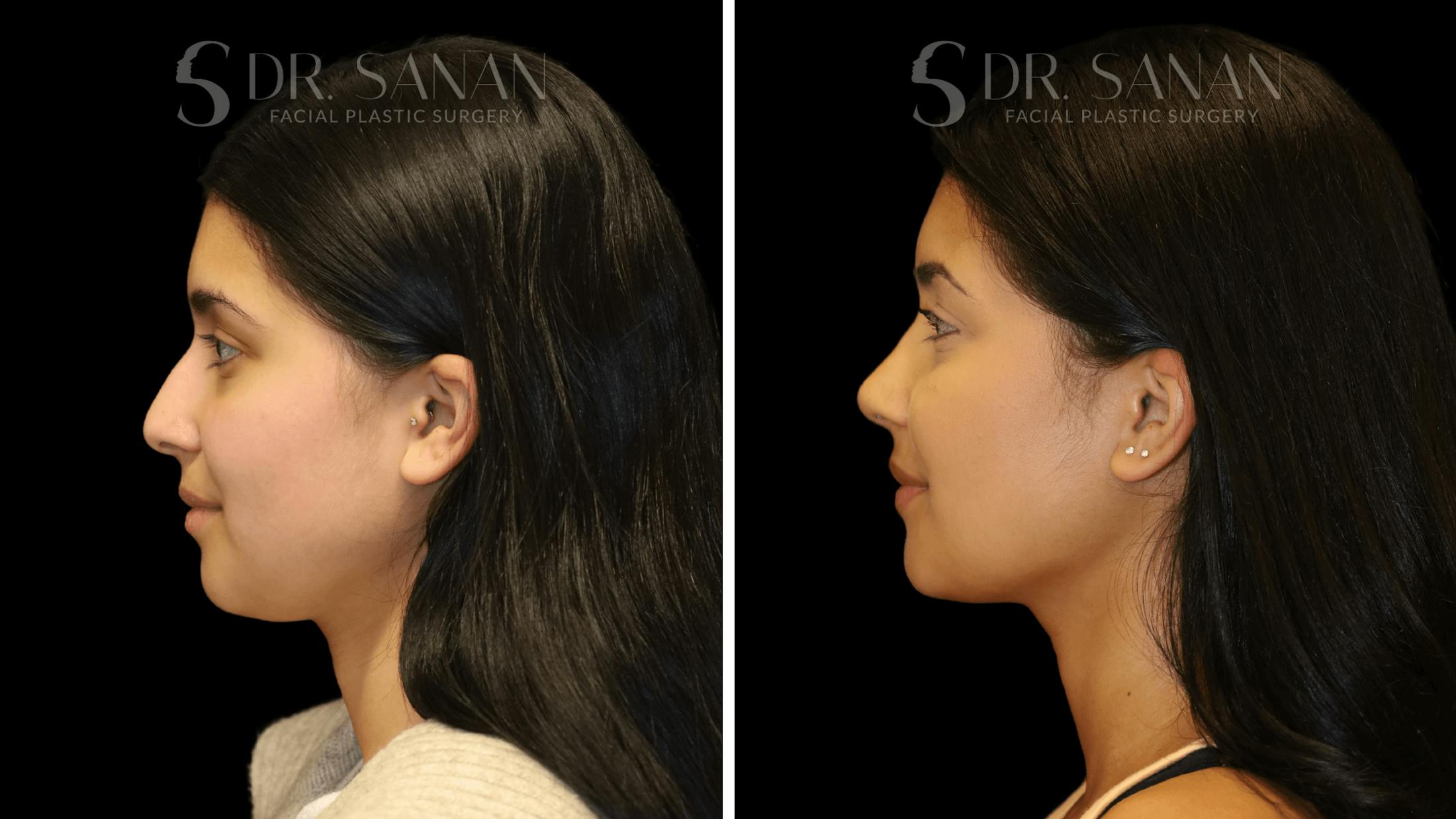 Rhinoplasty Before & After Gallery - Patient 142101 - Image 5