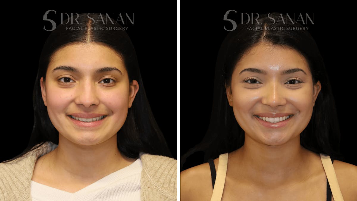Rhinoplasty Before & After Gallery - Patient 142101 - Image 2