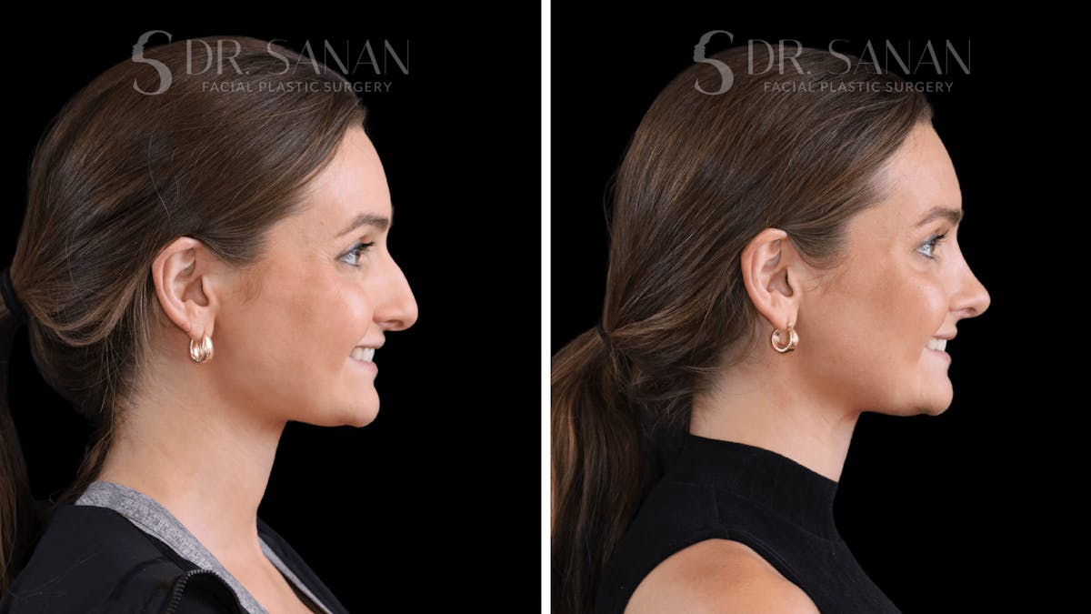 Rhinoplasty Before & After Gallery - Patient 438656 - Image 1
