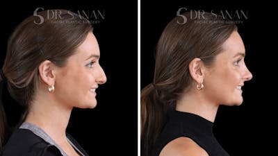 Rhinoplasty Before & After Gallery - Patient 438656 - Image 1