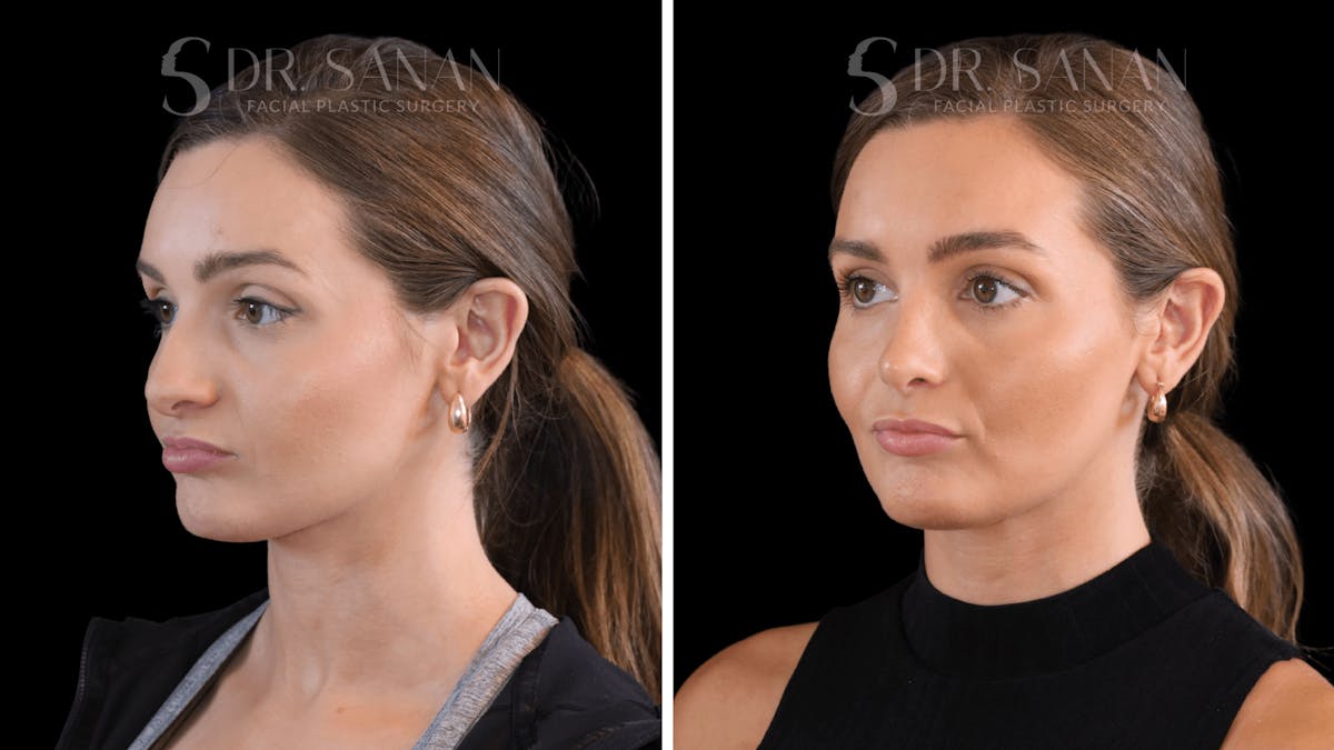 Rhinoplasty Before & After Gallery - Patient 438656 - Image 2
