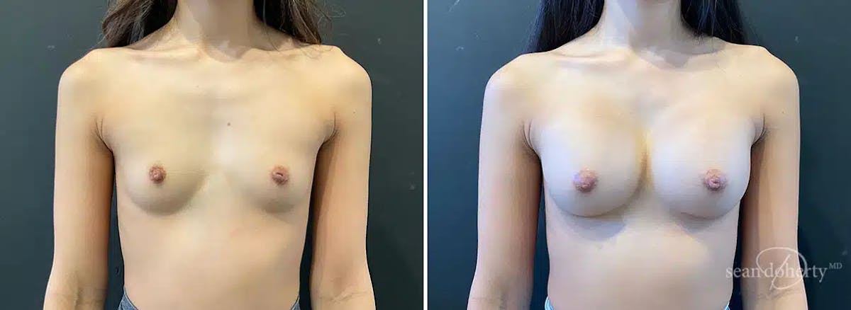 Breast Augmentation Before & After Gallery - Patient 291603 - Image 1