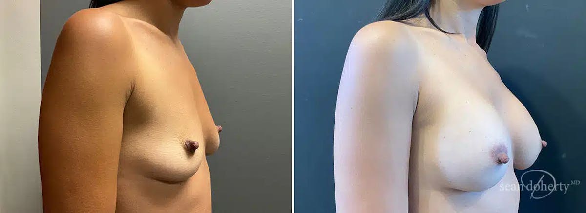 Breast Augmentation Before & After Gallery - Patient 328598 - Image 3