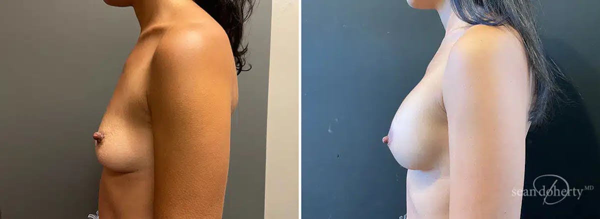 Breast Augmentation Before & After Gallery - Patient 328598 - Image 2