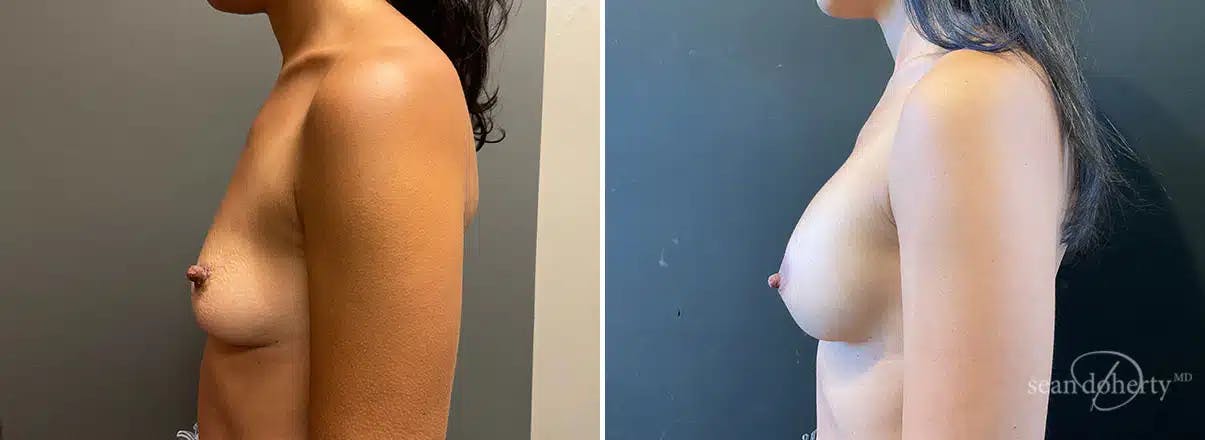 Breast Augmentation Before & After Gallery - Patient 328598 - Image 2