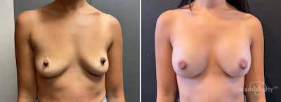 Breast Augmentation Before & After Gallery - Patient 328598 - Image 1