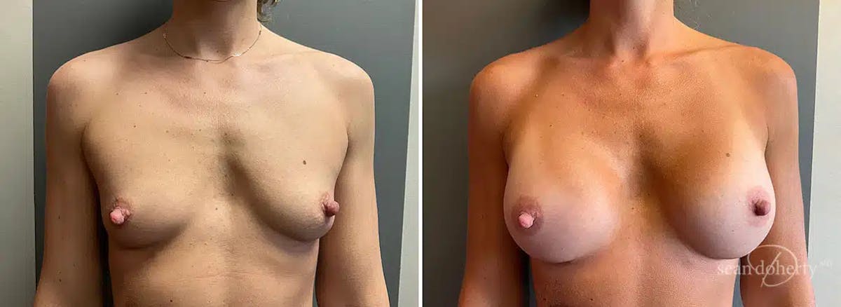 Breast Augmentation Before & After Gallery - Patient 436844 - Image 1