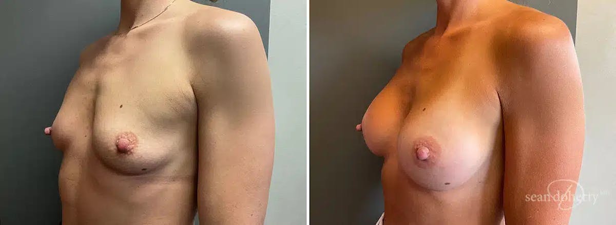 Breast Augmentation Before & After Gallery - Patient 436844 - Image 2