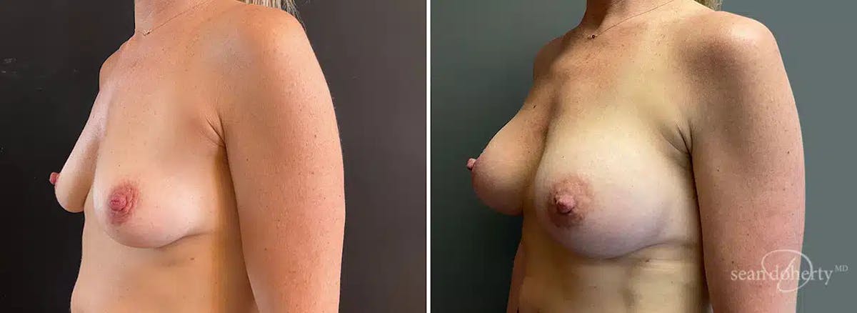 Breast Augmentation Before & After Gallery - Patient 615272 - Image 2