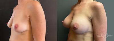 Breast Augmentation Before & After Gallery - Patient 615272 - Image 1