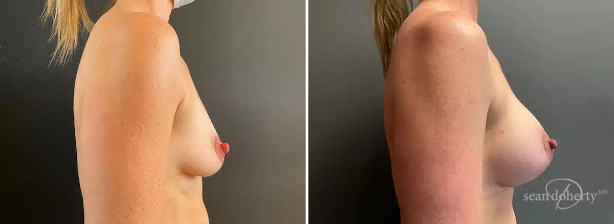 Breast Augmentation Before & After Gallery - Patient 615272 - Image 3