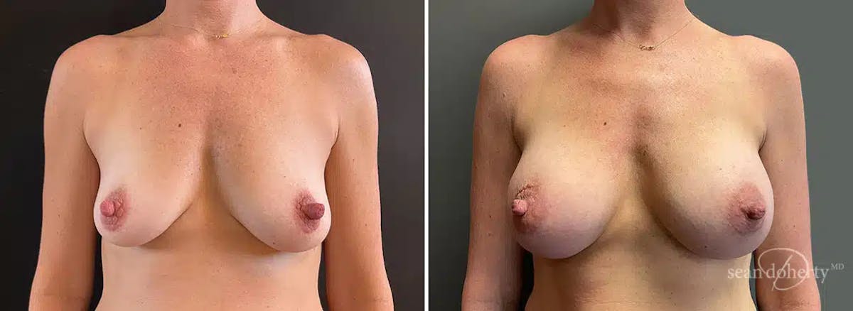 Breast Augmentation Before & After Gallery - Patient 615272 - Image 1