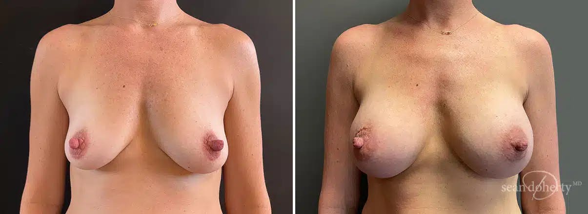 Breast Augmentation Before & After Gallery - Patient 615272 - Image 1