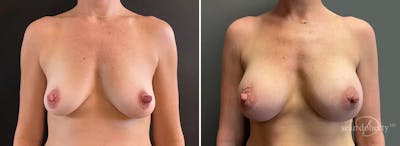 Breast Augmentation Before & After Gallery - Patient 615272 - Image 1