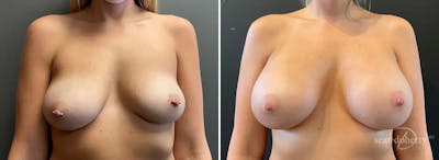 Breast Augmentation Before & After Gallery - Patient 995700 - Image 1